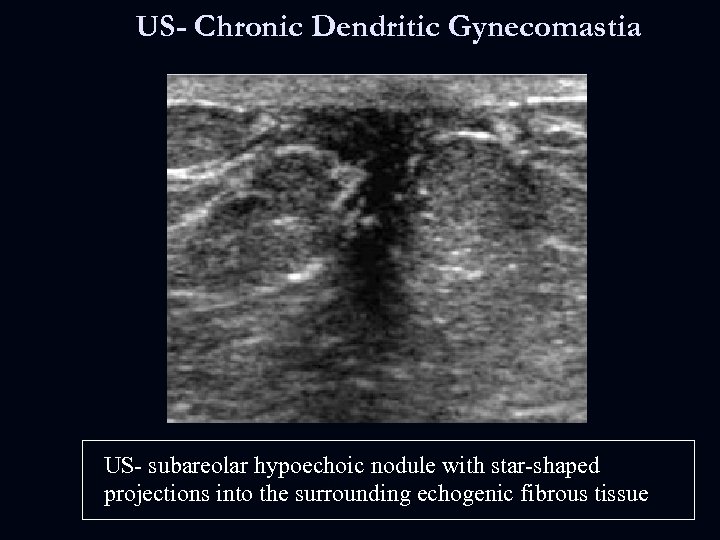 US- Chronic Dendritic Gynecomastia US- subareolar hypoechoic nodule with star-shaped projections into the surrounding
