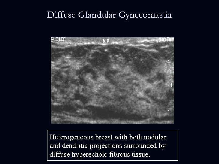 Diffuse Glandular Gynecomastia Heterogeneous breast with both nodular and dendritic projections surrounded by diffuse