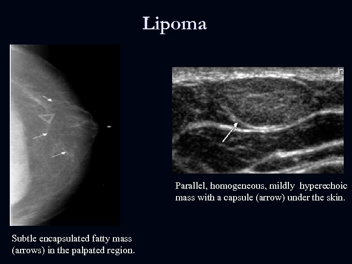 Lipoma Parallel, homogeneous, mildly hyperechoic mass with a capsule (arrow) under the skin. Subtle