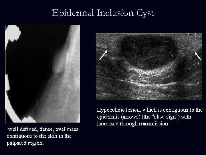 Epidermal Inclusion Cyst well defined, dense, oval mass contiguous to the skin in the