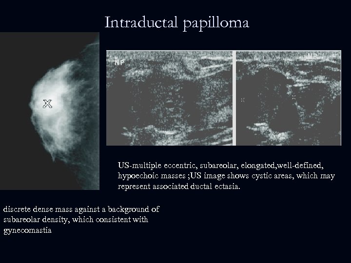 Intraductal papilloma US-multiple eccentric, subareolar, elongated, well-defined, hypoechoic masses ; US image shows cystic