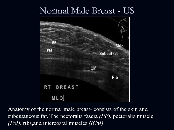 Normal Male Breast - US Anatomy of the normal male breast- consists of the