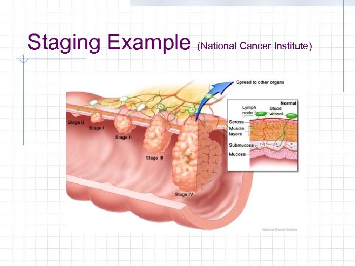 Staging Example (National Cancer Institute) 