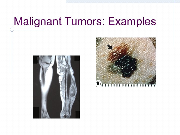 Malignant Tumors: Examples 