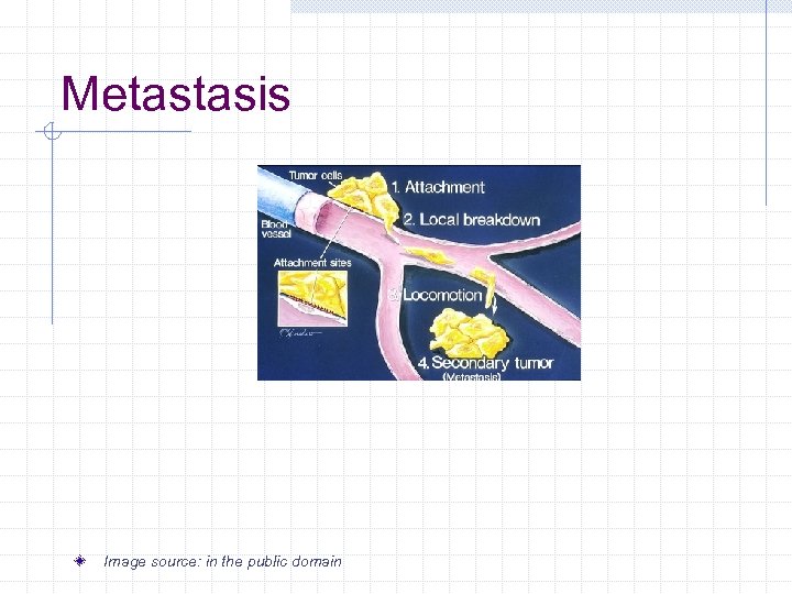 Metastasis Image source: in the public domain 