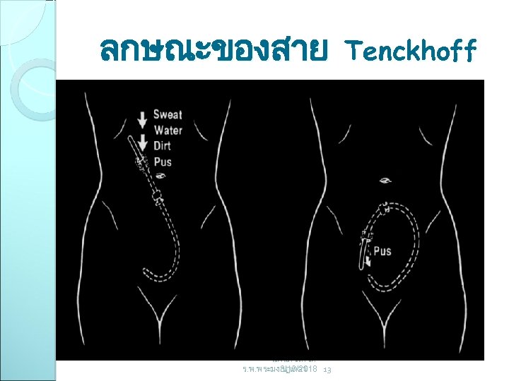 ลกษณะของสาย แผนกโรคไต ร. พ. พระมงกฎเกลา 3/16/2018 13 Tenckhoff 
