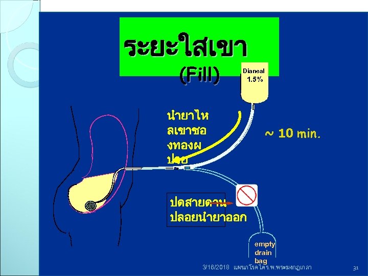 ระยะใสเขา (Fill) Dianeal 1. 5% นำยาไห ลเขาชอ งทองผ ปวย ~ 10 min. ปดสายดาน ปลอยนำยาออก