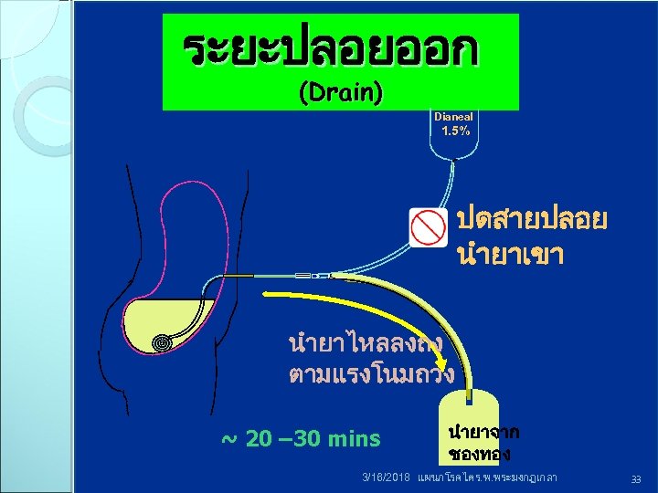 ระยะปลอยออก (Drain) Dianeal 1. 5% ปดสายปลอย นำยาเขา นำยาไหลลงถง ตามแรงโนมถวง ~ 20 – 30 mins