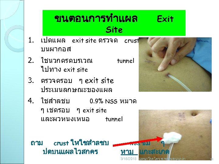 ขนตอนการทำแผล Site Exit 1. เปดแผล exit site ตรวจด crust บนผากอส 2. ใชนวกดรดบรเวณ ไปทาง exit