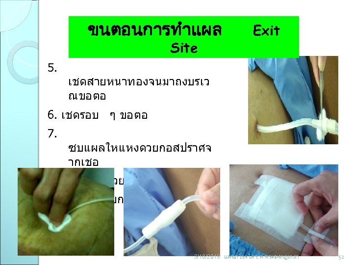 ขนตอนการทำแผล Site 5. Exit เชดสายหนาทองจนมาถงบรเว ณขอตอ 6. เชดรอบ ๆ ขอตอ 7. ซบแผลใหแหงดวยกอสปราศจ ากเชอ 8.