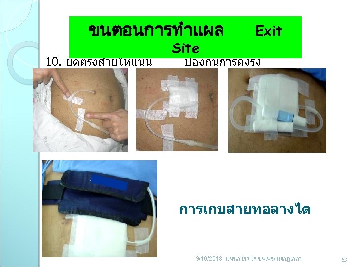 ขนตอนการทำแผล 10. ยดตรงสายใหแนน C- Shape Site Exit ปองกนการดงรง การเกบสายทอลางไต 3/16/2018 แผนกโรคไต ร. พ. พระมงกฎเกลา