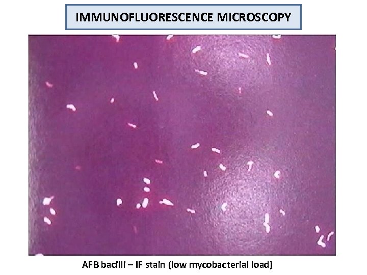IMMUNOFLUORESCENCE MICROSCOPY AFB bacilli – IF stain (low mycobacterial load) 