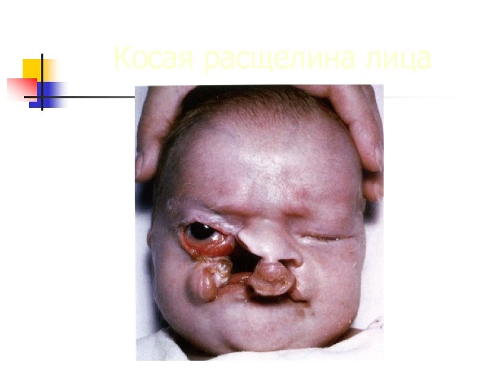 Косая расщелина лица 