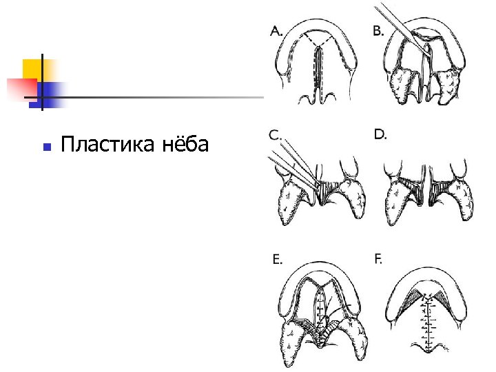 Обозначьте на рисунке виды расщелин