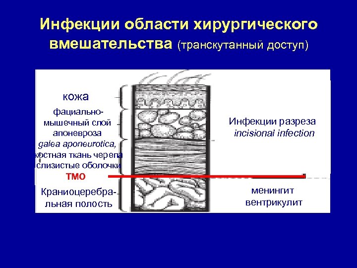 Инфекции области хирургического вмешательства (транскутанный доступ) кожа фациальномышечный слой апоневроза galea aponeurotica, костная ткань