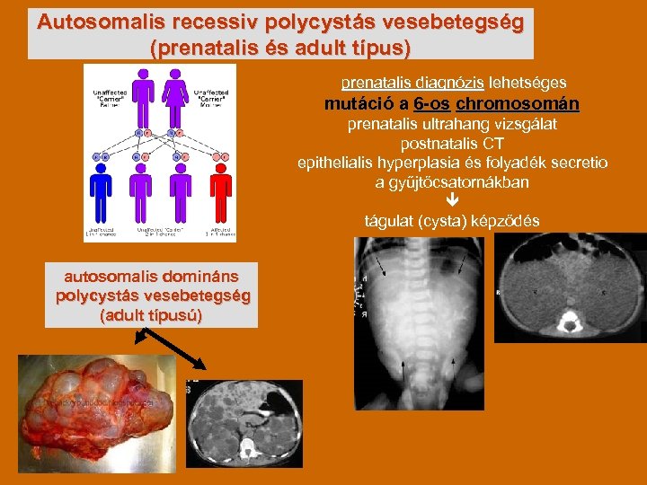 Autosomalis recessiv polycystás vesebetegség (prenatalis és adult típus) prenatalis diagnózis lehetséges mutáció a 6