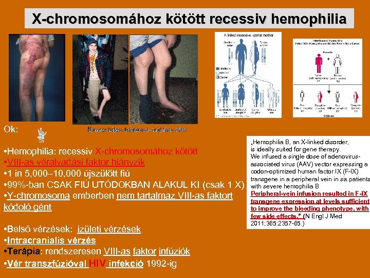 X-chromosomához kötött recessiv hemophilia Ok: • Hemophilia: recessiv X-chromosomához kötött • VIII-as véralvadási faktor