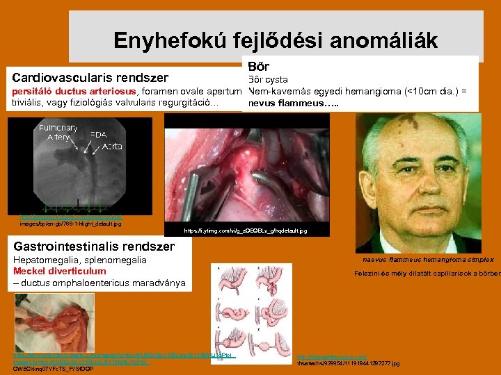 Enyhefokú fejlődési anomáliák Bőr Cardiovascularis rendszer Bőr cysta persitáló ductus arteriosus, foramen ovale apertum