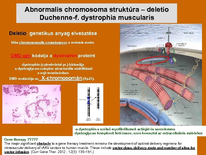 Abnormalis chromosoma struktúra – deletio Duchenne-f. dystrophia muscularis Deletio: genetikus anyag elvesztése hiba chromosomalis