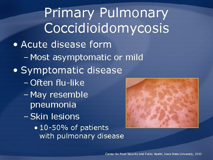 Primary Pulmonary Coccidioidomycosis • Acute disease form – Most asymptomatic or mild • Symptomatic