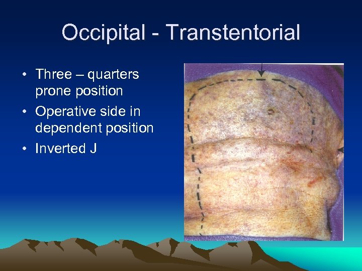 Occipital - Transtentorial • Three – quarters prone position • Operative side in dependent