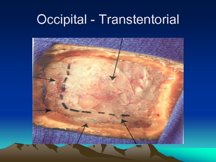 Occipital - Transtentorial 