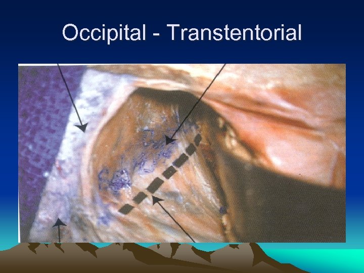 Occipital - Transtentorial 