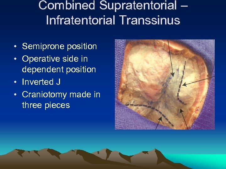 Combined Supratentorial – Infratentorial Transsinus • Semiprone position • Operative side in dependent position
