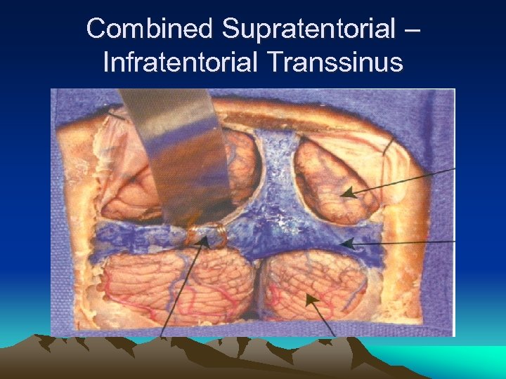 Combined Supratentorial – Infratentorial Transsinus 