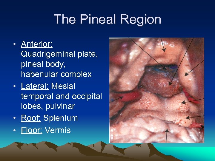 The Pineal Region • Anterior: Quadrigeminal plate, pineal body, habenular complex • Lateral: Mesial