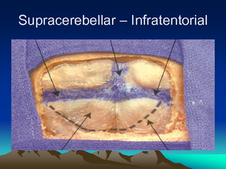 Supracerebellar – Infratentorial 