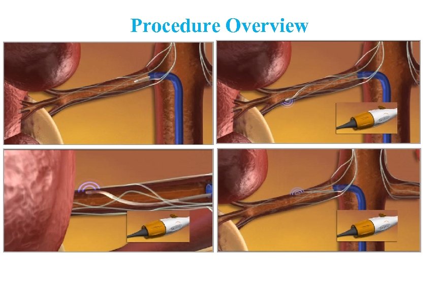 Procedure Overview 