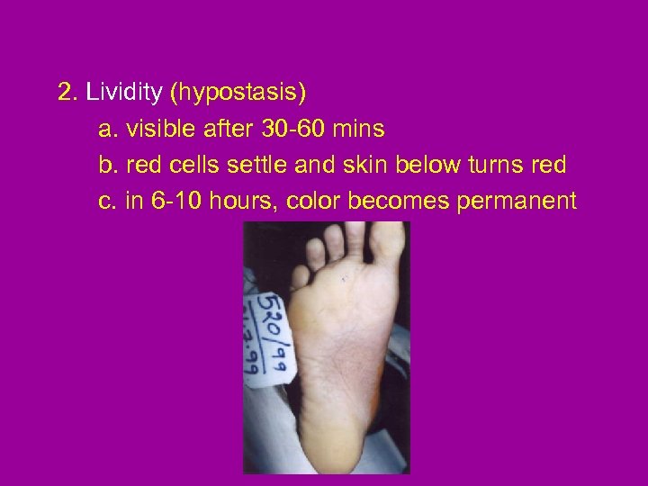 2. Lividity (hypostasis) a. visible after 30 -60 mins b. red cells settle and