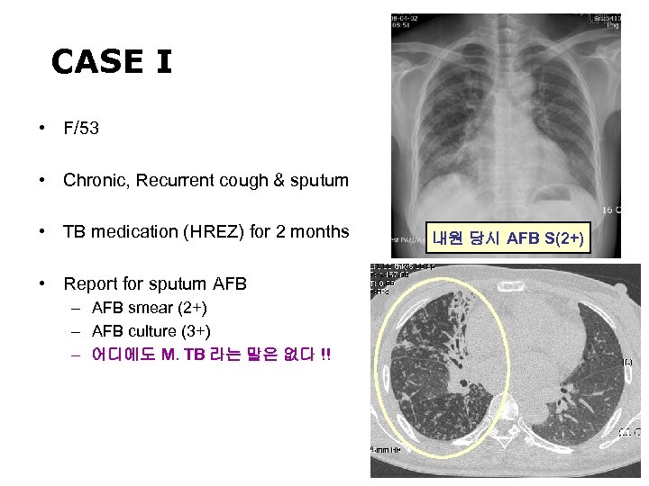 CASE I • F/53 • Chronic, Recurrent cough & sputum • TB medication (HREZ)