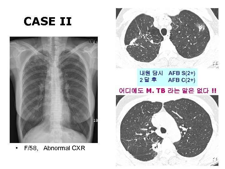 CASE II 내원 당시 AFB S(2+) 2달후 AFB C(2+) 어디에도 M. TB 라는 말은
