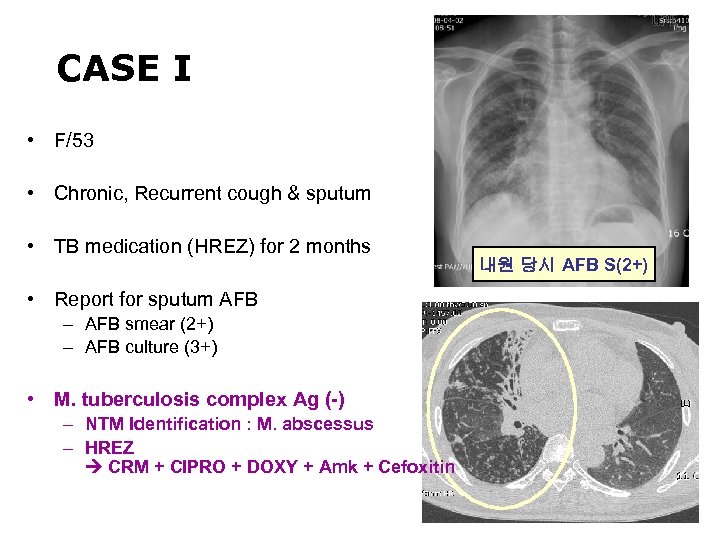 CASE I • F/53 • Chronic, Recurrent cough & sputum • TB medication (HREZ)