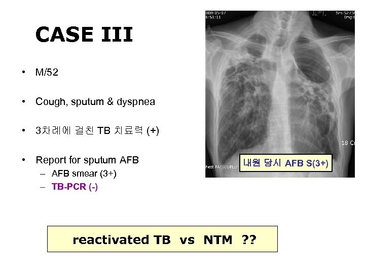 CASE III • M/52 • Cough, sputum & dyspnea • 3차례에 걸친 TB 치료력