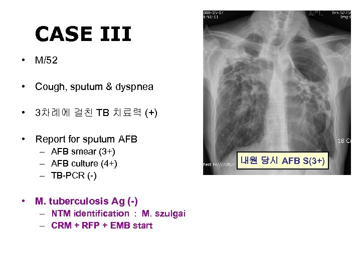 CASE III • M/52 • Cough, sputum & dyspnea • 3차례에 걸친 TB 치료력