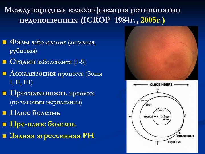 Международная классификация ретинопатии недоношенных (ICROP 1984 г. , 2005 г. ) n Фазы заболевания