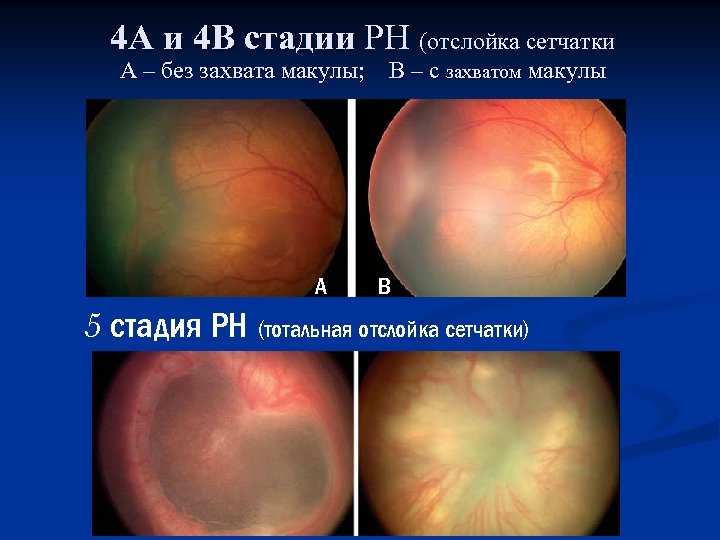 4 А и 4 В стадии РН (отслойка сетчатки А – без захвата макулы;