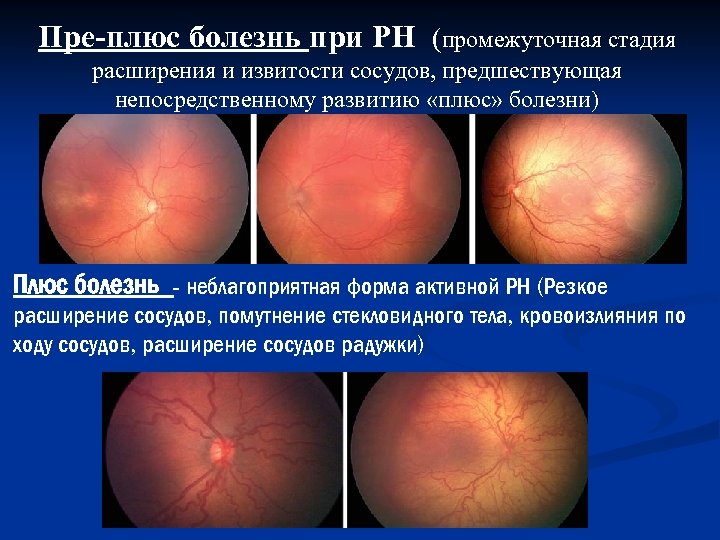 Пре-плюс болезнь при РН (промежуточная стадия расширения и извитости сосудов, предшествующая непосредственному развитию «плюс»