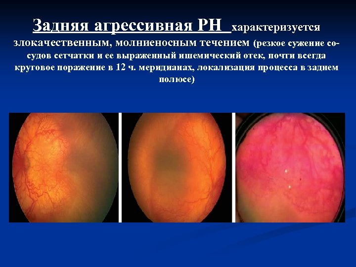 Задняя агрессивная РН характеризуется злокачественным, молниеносным течением (резкое сужение сосудов сетчатки и ее выраженный