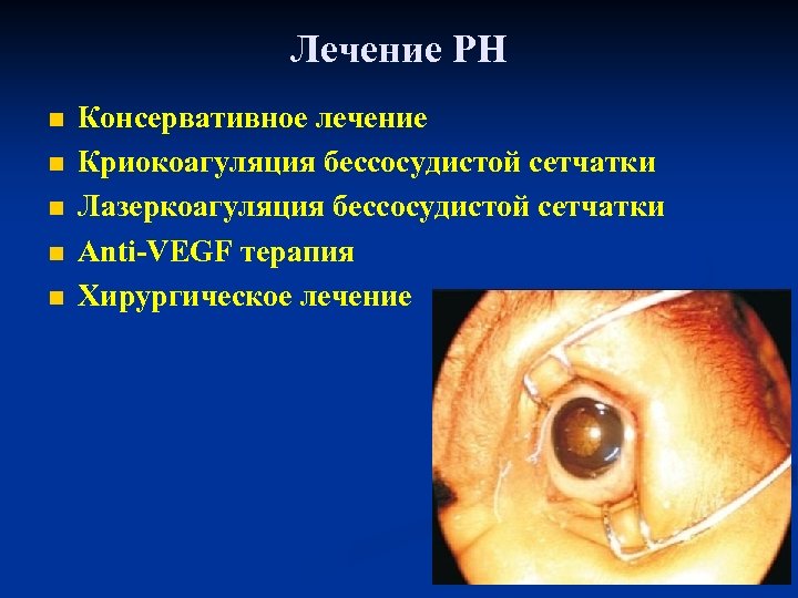 Лечение РН n n n Консервативное лечение Криокоагуляция бессосудистой сетчатки Лазеркоагуляция бессосудистой сетчатки Аnti-VEGF