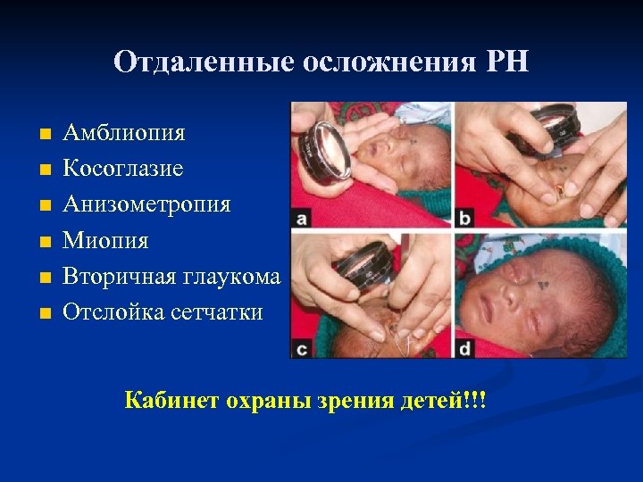 Отдаленные осложнения РН n n n Амблиопия Косоглазие Анизометропия Миопия Вторичная глаукома Отслойка сетчатки