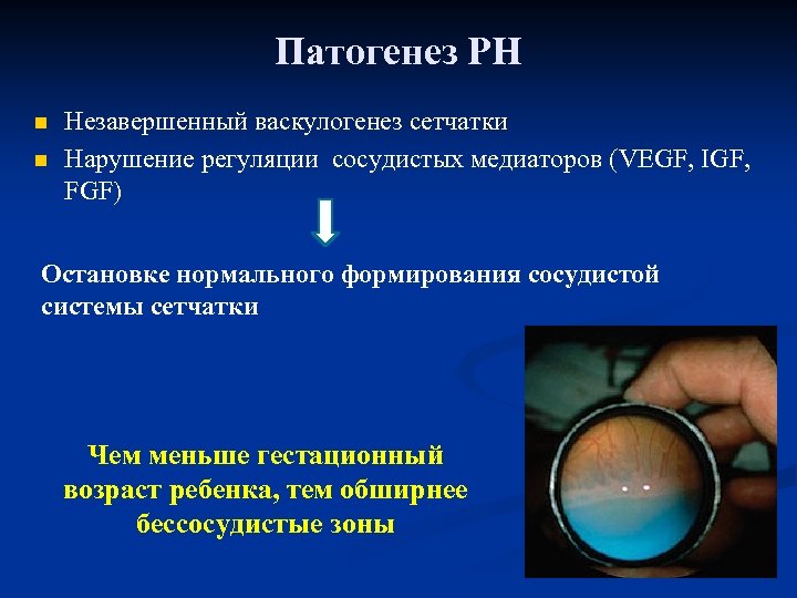 Патогенез РН n n Незавершенный васкулогенез сетчатки Нарушение регуляции сосудистых медиаторов (VEGF, IGF, FGF)