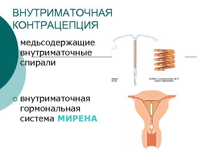 ВНУТРИМАТОЧНАЯ КОНТРАЦЕПЦИЯ ¡ ¡ медьсодержащие внутриматочные спирали внутриматочная гормональная система МИРЕНА 