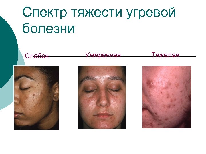 Спектр тяжести угревой болезни Слабая Умеренная Тяжелая 