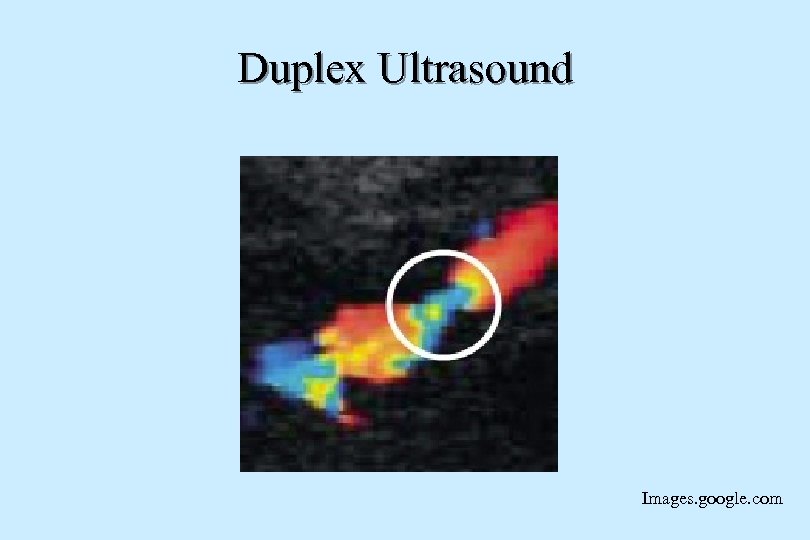 Duplex Ultrasound Images. google. com 