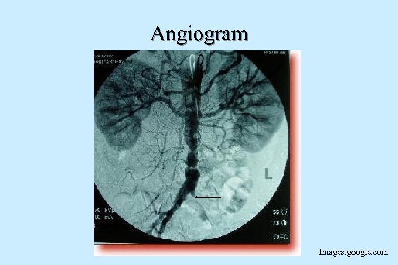 Angiogram Images. google. com 