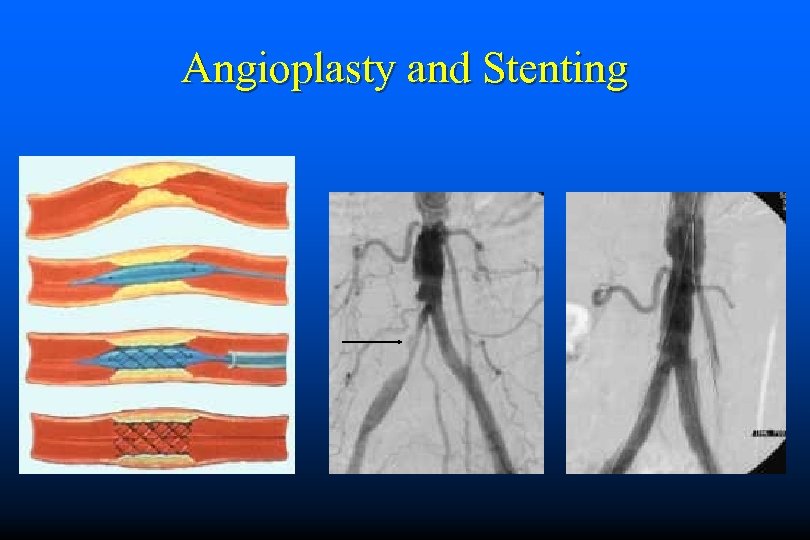 Angioplasty and Stenting 